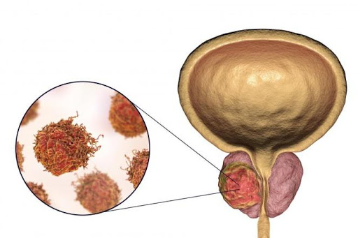 prostate cancer image